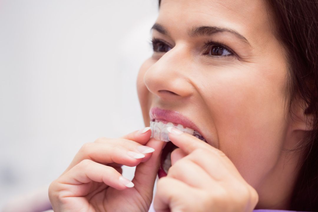 maintaining oral hygiene with dental aligners preventing infections effectively